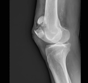 https://www.orthopolerenaison.fr/wp-content/uploads/2020/04/Fracture-rotule-Orthopole-Renaison-300x283.jpg